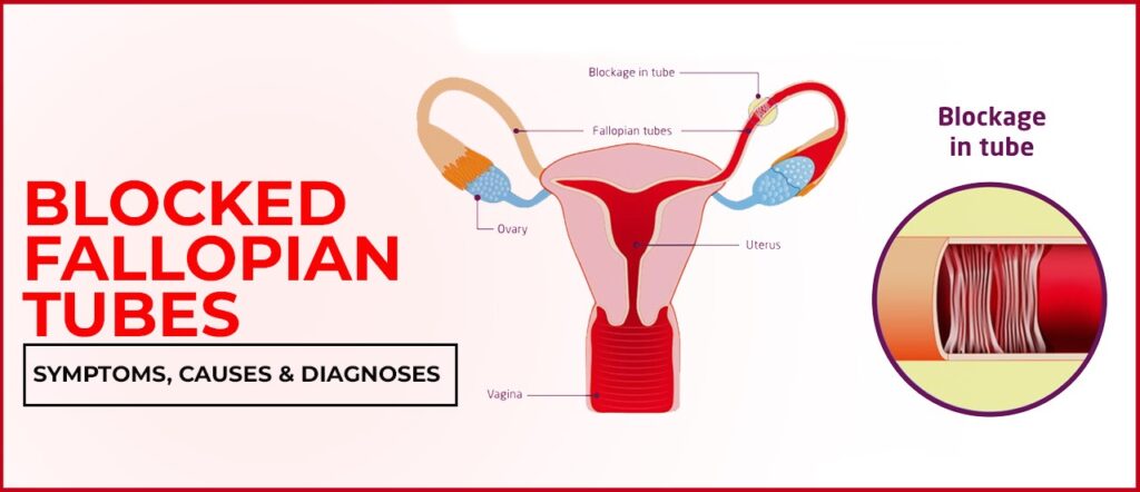 Blocked Fallopian Tubes