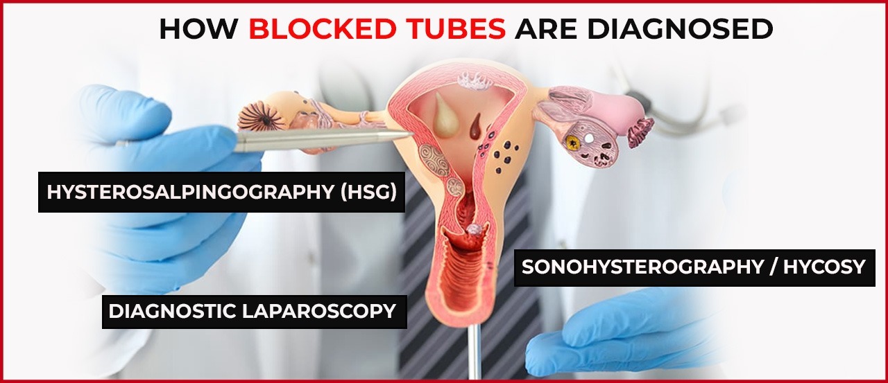Diagnosis of Blocked Fallopian Tubes